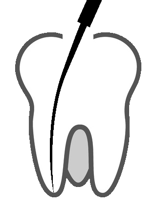 Imagen de endodoncia en la Clínica Dental Oíza-Colera