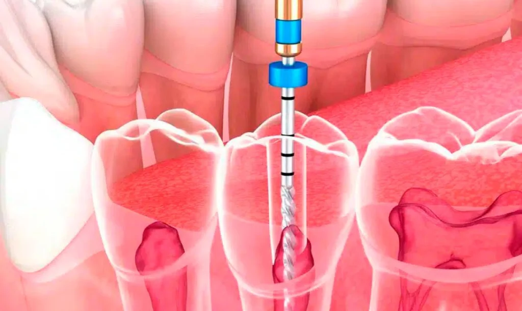 Tratamientos Endodoncia