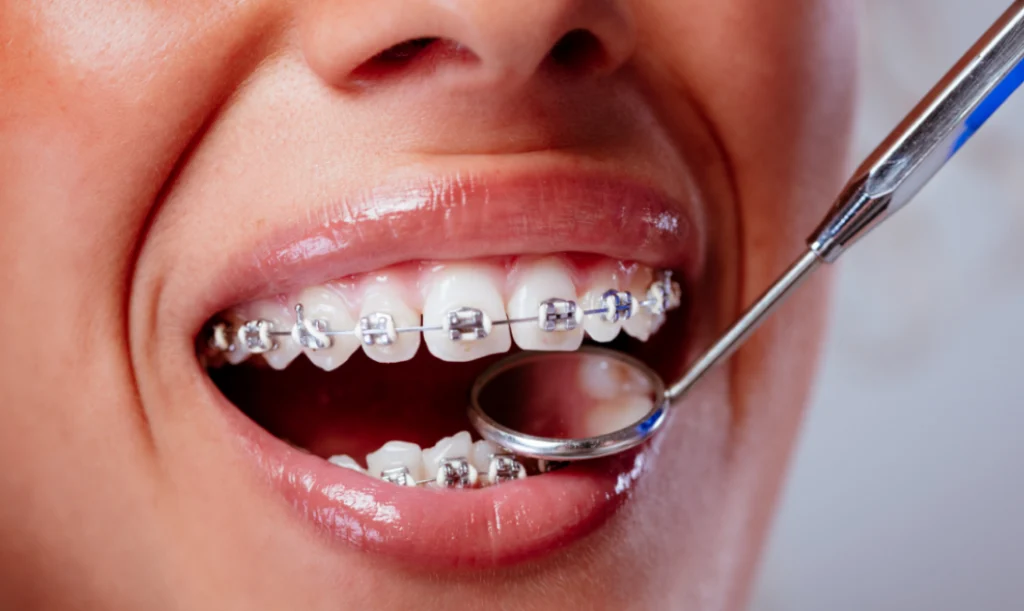 Tratamientos Ortodoncia